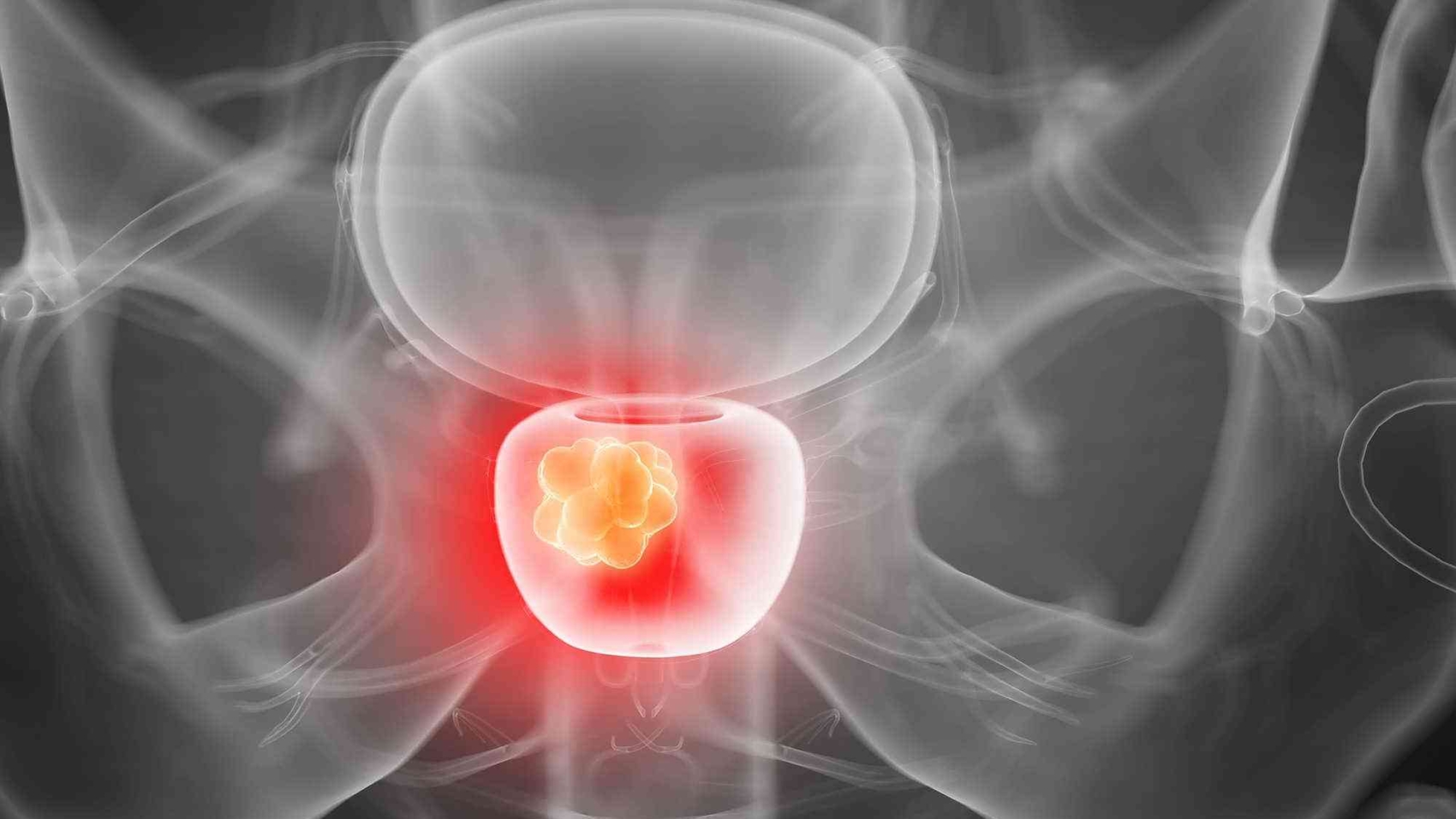 prostate-cancer-5_0