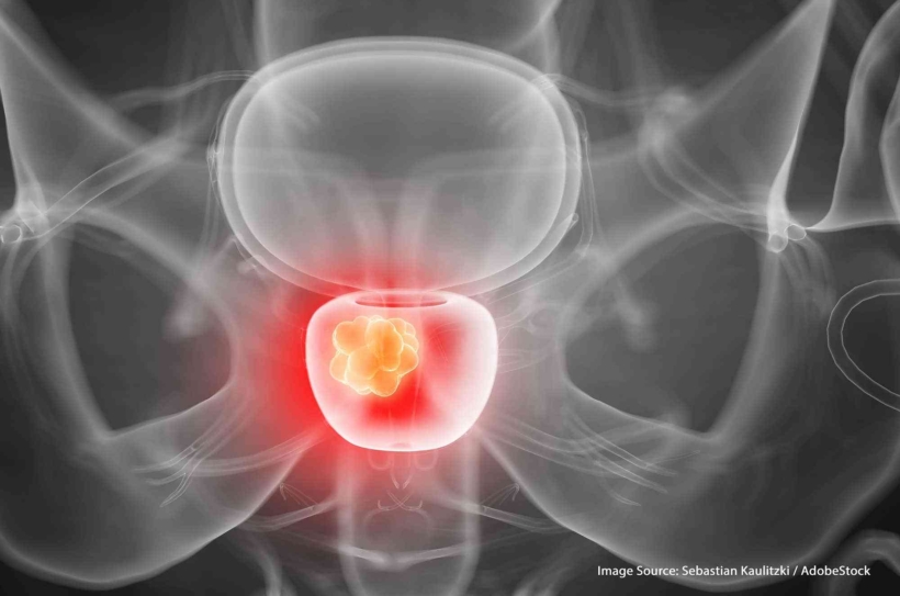 prostate-cancer-5_0